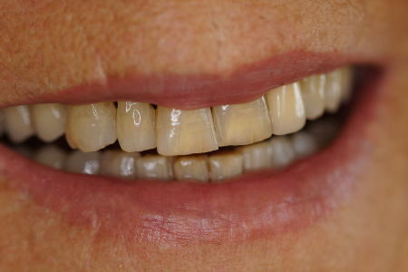 Zahnfarbe häufigste Implantologie und