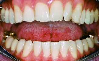 Häufigste zahnfarbe